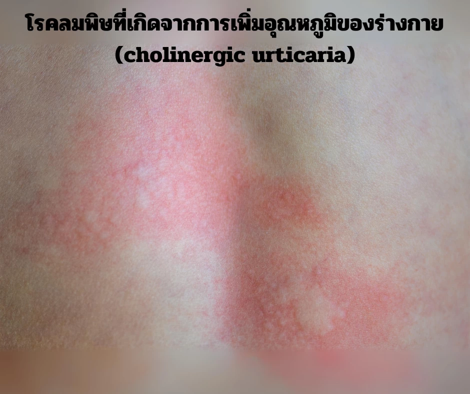 cholinergic urticaria